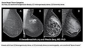 Breast Cancer Screening - Mammogram