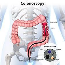 Colon Cancer Screening - Colonoscopy