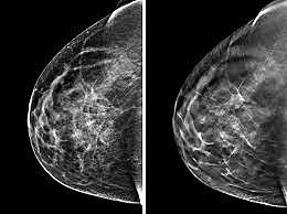First Mammogram