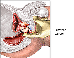 Prostate Cancer Testing
