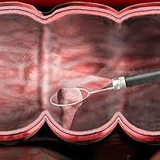 Colon Cancer Screening - Colonoscopy