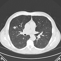 Lung Cancer Screening : CT Scan