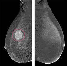 Mammogram Screening
