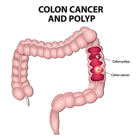 Colon/Rectal Cancer Screening (Colonoscopy)
