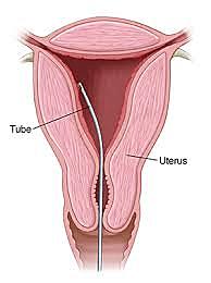Endometrial Cancer Screening