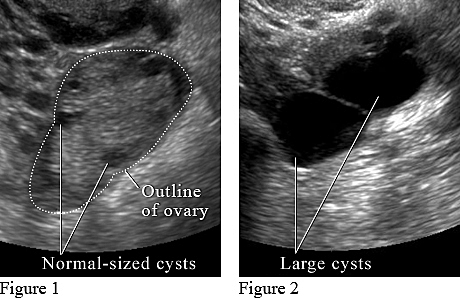 Transvaginal Ultrasound Image