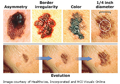 Skin Exam (Checking Spots)