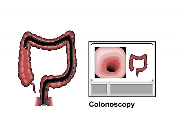 Colonoscopy