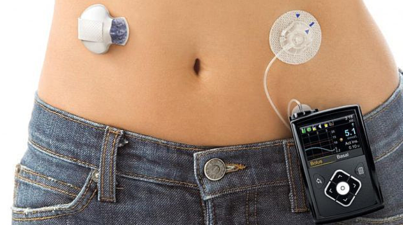 IMPLANTES CIBERNÉTICOS