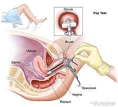 Cervical Cancer Screening