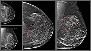 Mammogram