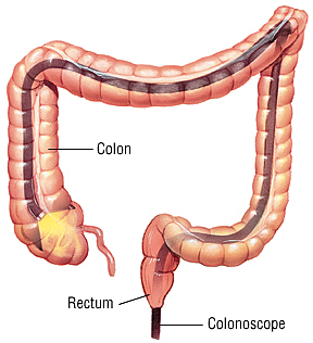 Colonoscopy