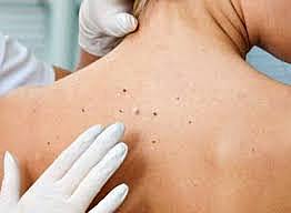 Skin Cancer Related Check up