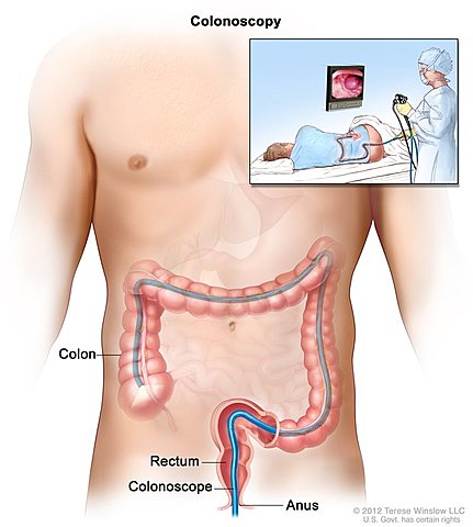 Colon Cancer Screen