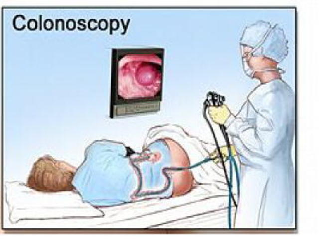 Colonoscopy