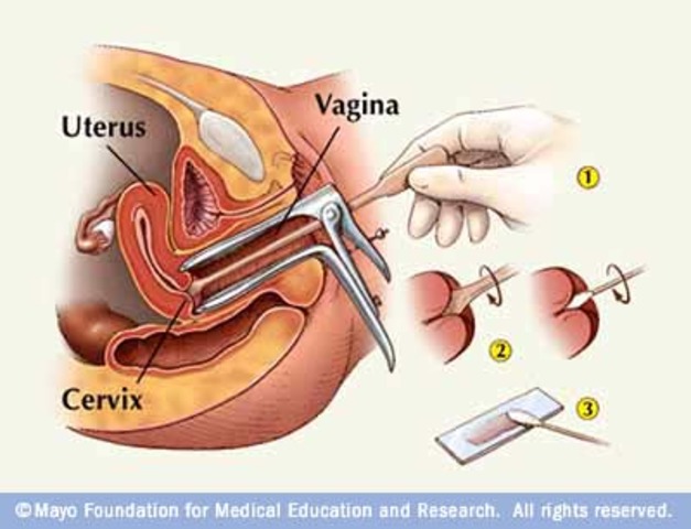 Cervical Cancer Screening