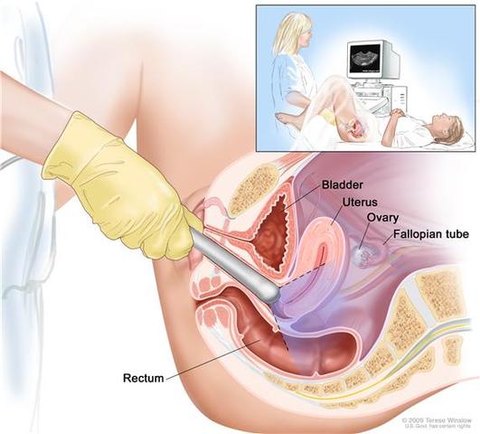 Endometrial Cancer Screening