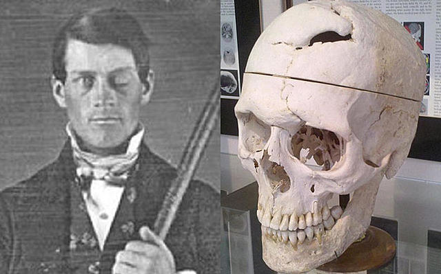 Phineas Gage Brain Injury