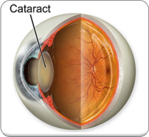 Monet was diagnosed with cataracts in each eye,