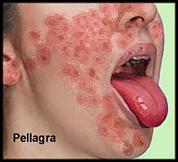 Se desscubre la Pelagra