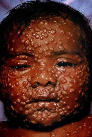 Smallpox eradicated