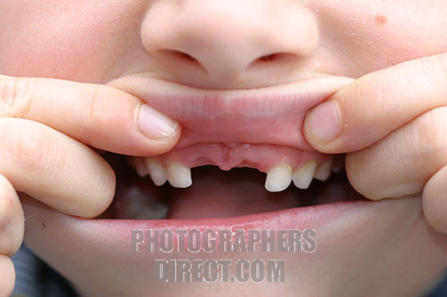 I knocked my front teeth out on the coffee table