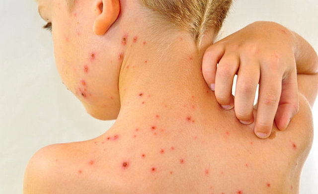 VACUNA CONTRA RUBÉOLA