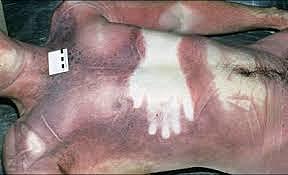 Signos para Diagnosticar la Muerte