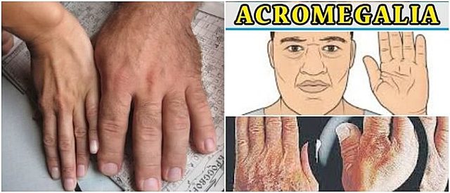 Pierre Marie acuña el término acromegalia