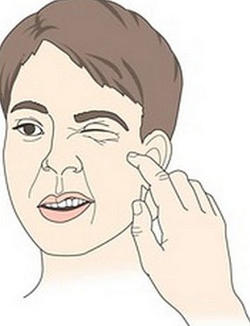 Chvostek caracteriza el signo que acuña su nombre