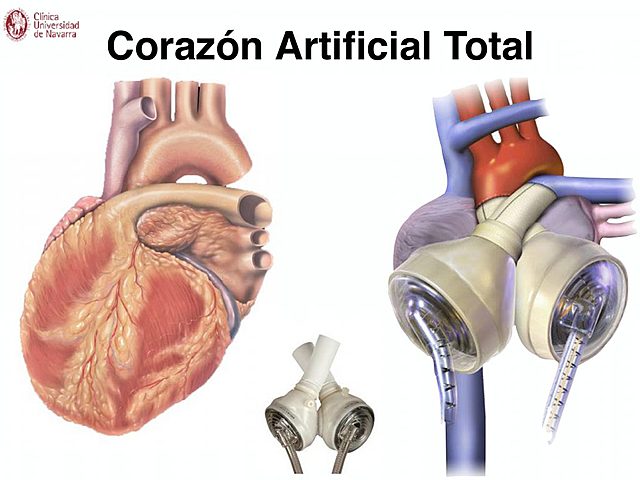 primera implantación de un corazón artificial