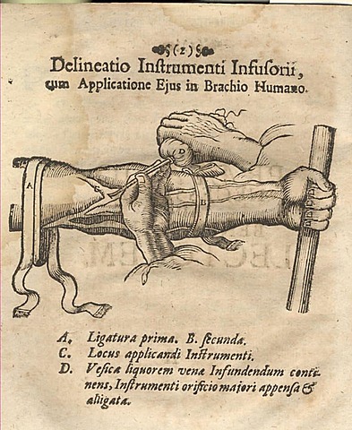 Primeira injeção IV em humanos. Johann D. Major.