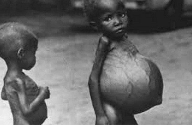 Enfermedad de "Kwashiorkor"