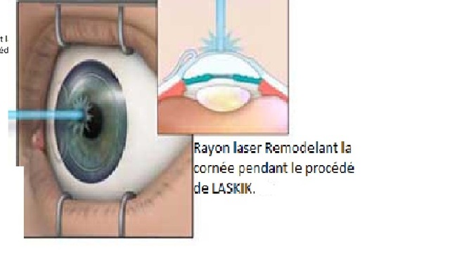 La Lazer sur tes yeux!