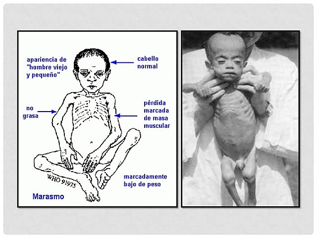 Enfermedad de "Kwashiorkor"