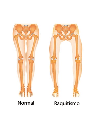 Identificacion del Raquitismo Incorrectamente
