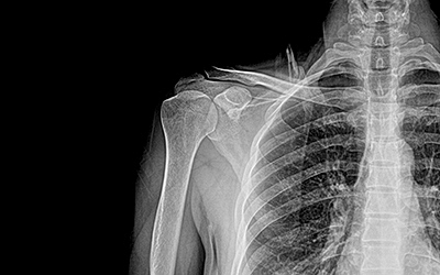 Roentgen descubre los rayos X