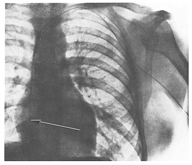 Primeira cateterização central. Werner Forssmann.