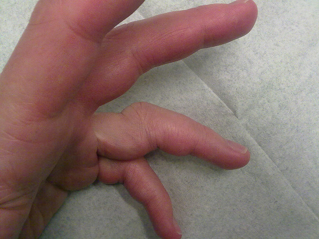 au m'n vinger gebroken