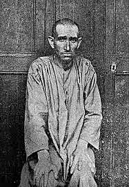 Parálisis General Progresiva