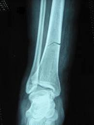 mi pequeña fractura