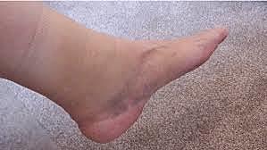 The Day I Sprained my Ankle