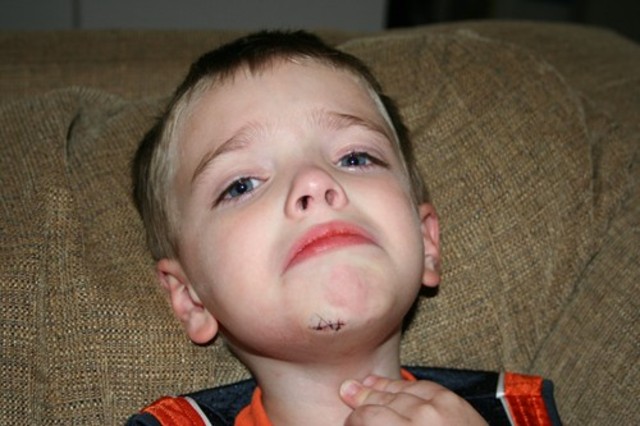 Almost got stitches on my chin