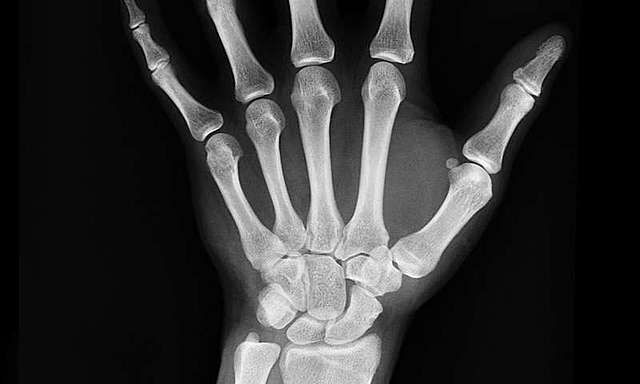 X-rays are Discovered