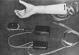 Prótesis Mioeléctricas