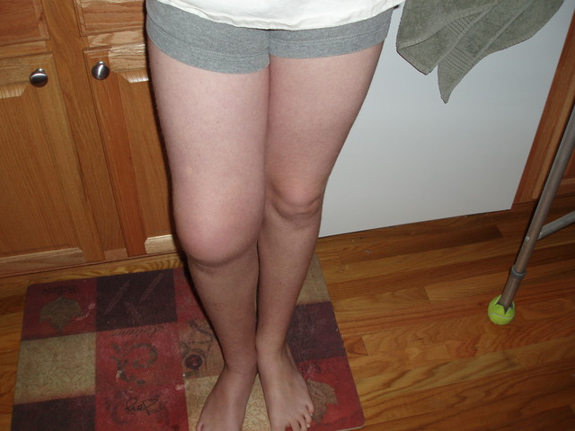 dislocated knee again