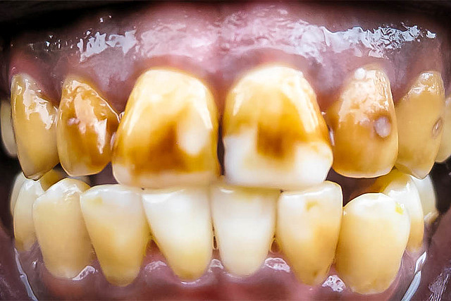 El Dr Black investigo la fluorosis por 6 años hasta su muerte.