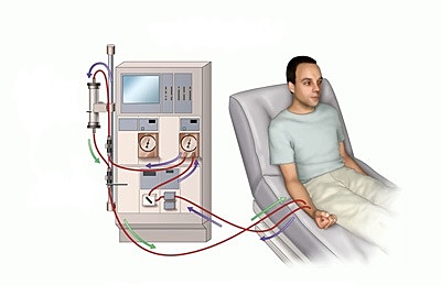 Desenvolupament de la diàlisi per a la insuficiència renal