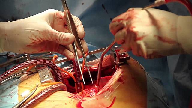 Trasplantaments de cor amb èxit en éssers humans