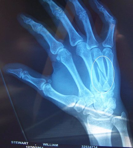 had surgery on myh handd :(